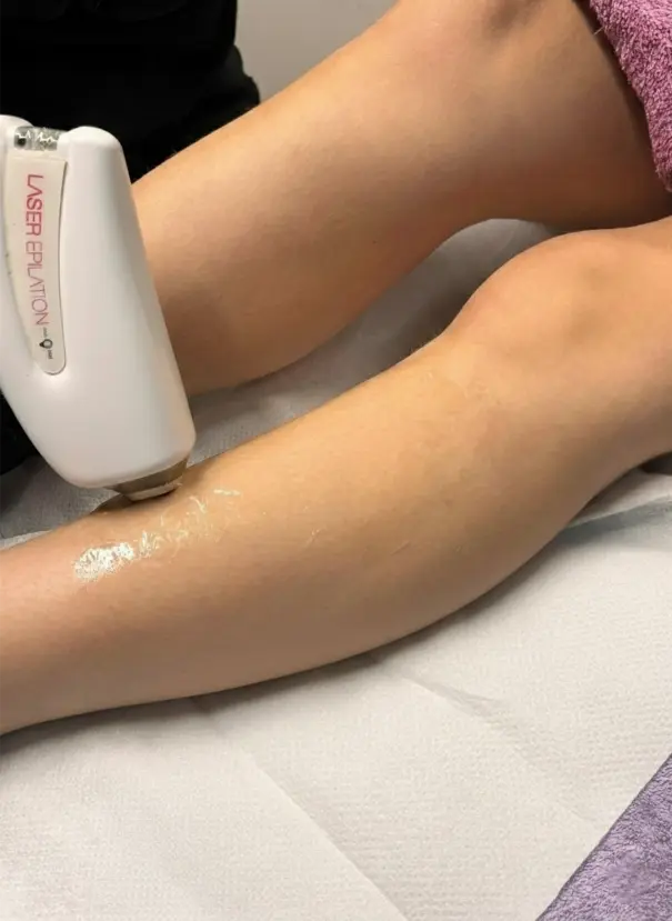 Epilazione e laser Verona
